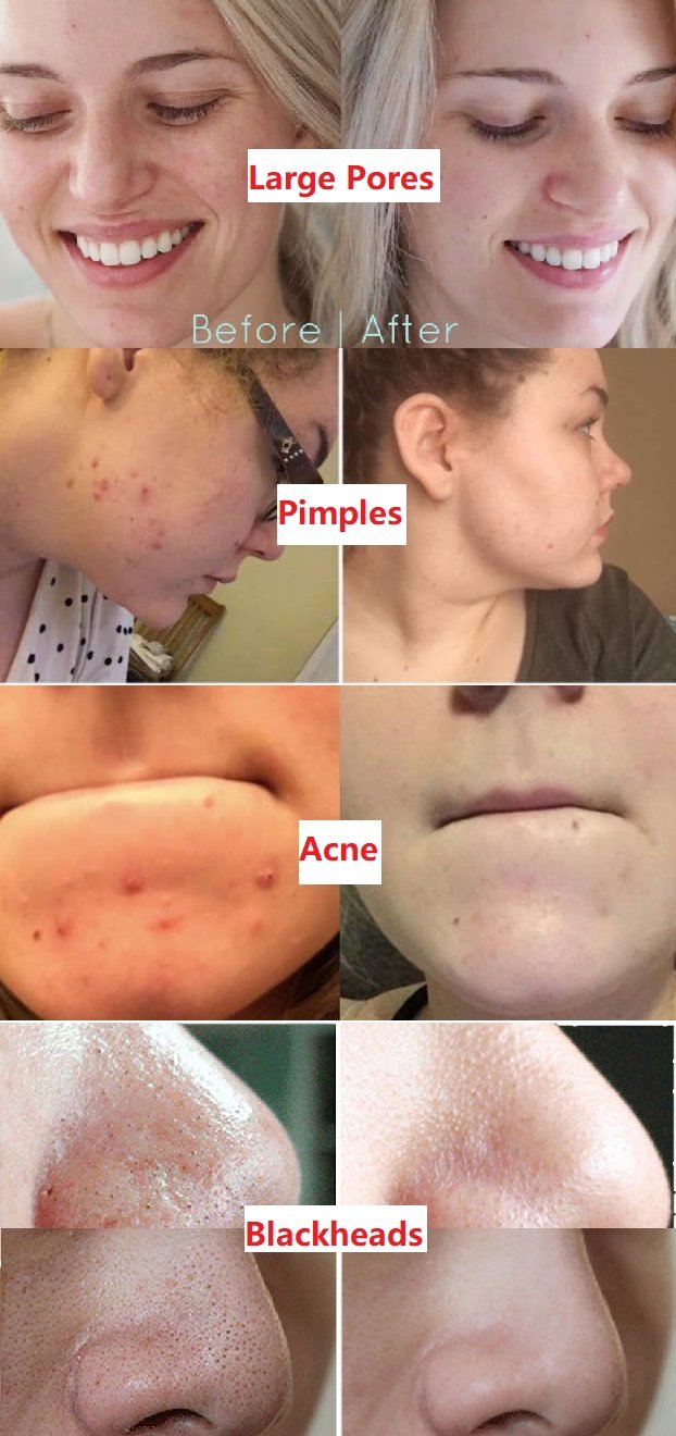 Kuuma myynti -Syväpuhdistava vihreä tee naamio